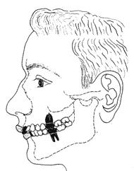 1. Oclusão dentária O ortodontista Angle (1899), agrupou a oclusão dentária em três Classes, tendo como referência o posicionamento do primeiro molar superior em relação ao primeiro molar inferior.