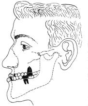 A Classe III ocorre quando a cúspide mésio-vestibular do primeiro molar superior oclui distalmente ao sulco mésio-vestibular do primeiro molar inferior. Figura 3- Classe III de Angle 2.