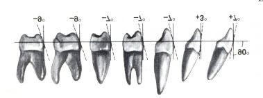 3. Terceira chave de oclusão: inclinações dentárias relação positiva dos incisivos superiores, ou seja, da superfície incisal para a vestibular em relação à porção cervical; relação negativa dos