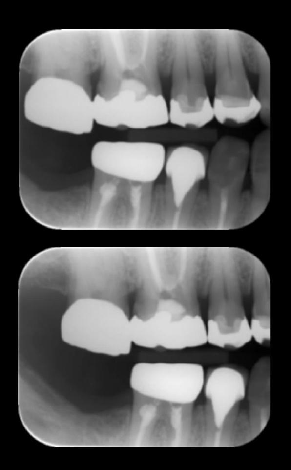 Paciente do gênero feminino, 56 anos. Radiografias interproximais da região de pré-molares e molares, lado direito.