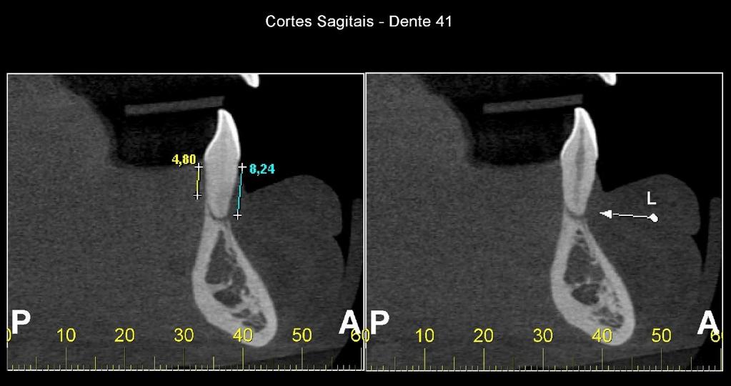 Apesar das técnicas radiográficas intra orais mostrarem, com riqueza de detalhes, informações importantes ao clínico, devemos lembrar que as radiografias periapicais e interproximais, por exemplo,