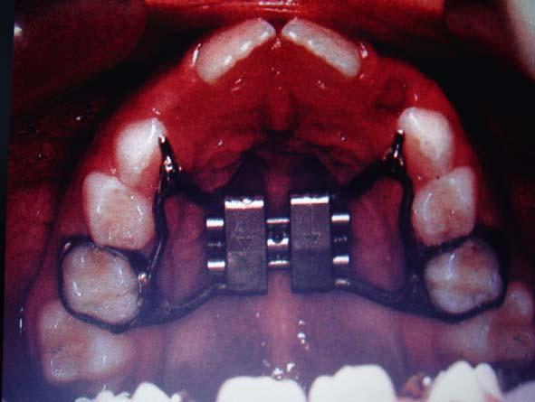 21 maxilar foi avaliada clinicamente, pela oclusão do paciente, podendo utilizar inicialmente os modelos em gesso para quaisquer comparações.