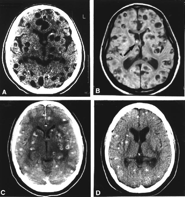 Figura 3. Características de neuroimagem (TC e RNM) dos cistos cisticercóticos nos seus diferentes estágios de evolução.