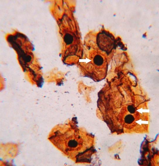 Figura 2 Células de Mangaba (Hancornia speciosa Gómez) coradas com nitrato de Prata. As regiões mais escuras apontadas pelas setas são os nucléolos.