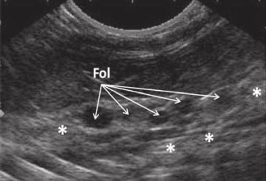 320 Francisco C.P. Neto et al. Fig.3. Imagem ultra-sonográfica sagital do terço caudal da cavidade celomática da jibóia (Boa constrictor), demonstrando folículos ovarianos (Fol) de formato ovóide,