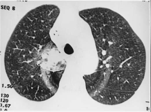 Oliveira P et al. Figura 1. Pneumonia por Gram negativos.