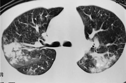 Comprometimento pulmonar nas leucemias: avaliação por TCR Figura 4. spergilose pulmonar.