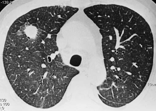 Comprometimento pulmonar nas leucemias: avaliação por TCR Figura 9. Linfoma.