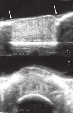 pré-operatório (L longitudinal / T transversal) Figura 3 - Imagens ultra-sonográficas do tecido neoformado, 45 dias após a cirurgia, no