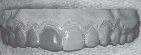 A placa utilizada na confecção destas moldeiras foi a cristal soft, redonda, de 1 mm de espessura (Bio Art), sendo