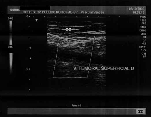 Figura 2 - Ultrassonografia Collor-Doppler de veia femoral superficial, mostrando-se não compressível e com ausência de fluxo.