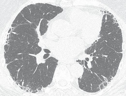 Manifestações intratorácicas das doenças do colágeno na TCR Figura 1. Padrão de pneumonia intersticial não-específica em paciente com esclerose sistêmica progressiva.
