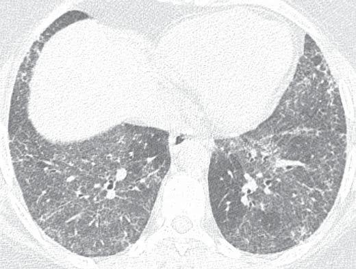 Semelhante à forma idiopática, o padrão de pneumonia intersticial não-específica na doença do colágeno tem melhor prognóstico do que o padrão de pneumonia intersticial usual (13).