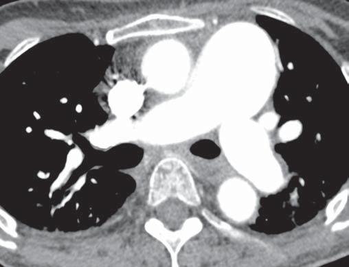 Estes achados corresponderam a alterações de injúria pulmonar aguda (dano alveolar difuso) idiopática em paciente com fibrose pulmonar e doença do colágeno. Figura 7.