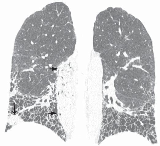 Manifestações intratorácicas das doenças do colágeno na TCR moconiose (principalmente a pneumoconiose dos trabalhadores de carvão) é designada de síndrome de Caplan (19).
