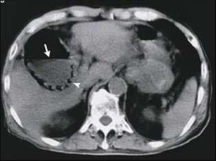 A inflamação é primariamente devida à estase biliar (inflamação química), posteriormente, sobrevém infecção.