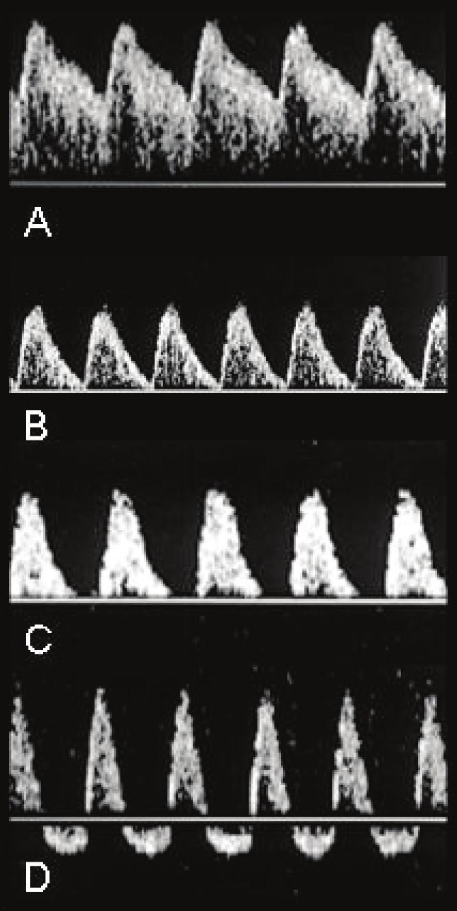 Ocorrendo distensão máxima da miofibrila cardíaca, a descompensação cardíaca é inevitável, frente ao incremento do retorno venoso, à crescente impedância vascular placentária e à oxigenação