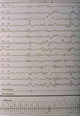 Convulsões Neonatais Benignas Familiares e não-familiares Epilepsia, 48 (Suppl.