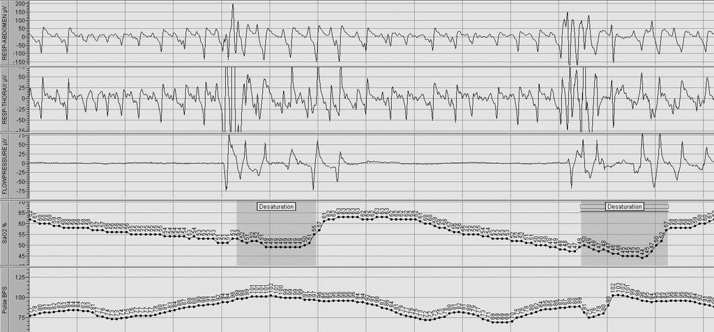 DPOC + SAOS: OVERLAP SYNDROME HIPERCAPNIA HIPERTENSÃO PULMONAR MORTALIDADE Flenley DC.