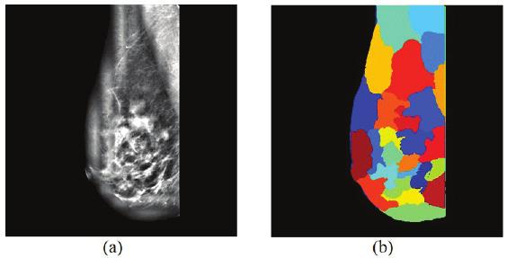 1 Melhoramento da imagem O uso de imagens mamográficas que apresentam boa qualidade torna-se um fator decisivo para o sucesso dos sistemas de auxílio à detecção.