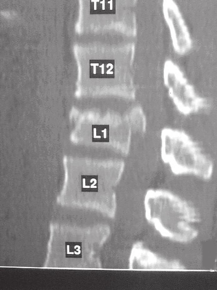 128 QUADRO 1 Classificação de Magerl et al. para as fraturas da coluna toracolombar (1994) 2 Tipo Grupo Subgrupo A: A1: impactadas A1.1 impacção da placa vertebral Compressão A1.2 encunhamento A1.