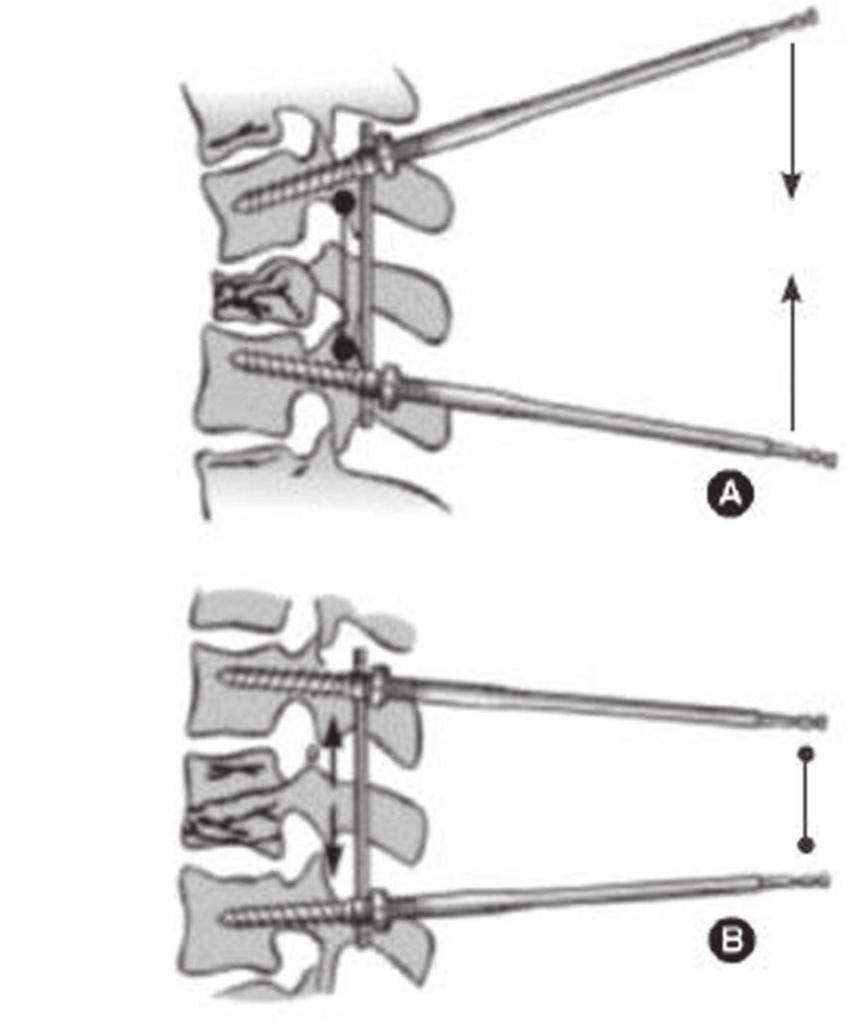 2 rotura do disco + fratura tipo A posterior B2: lesão B2.1 fratura transversa (fratura de Chance) óssea B2.2 espondilólise com lesão do disco posterior B2.