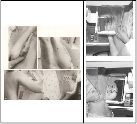 movimento involuntário da paciente é indicado que a mesma posicione a mão contralateral a mama examinada no aparelho, a mama deve ser bem comprimida e incluído toda a porção medial da mama
