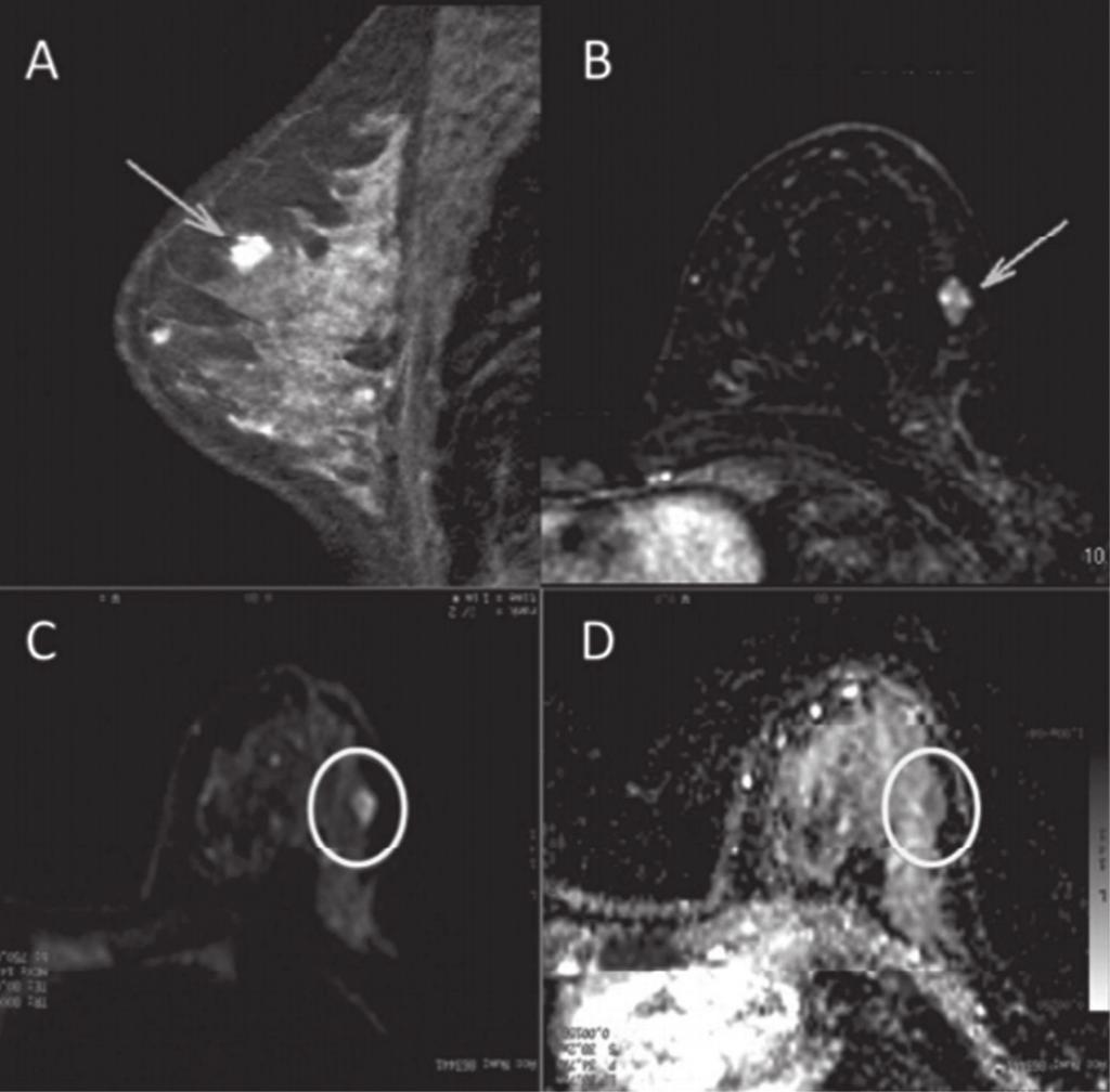 Reconstruções MIP da sequência com subtração pós-contraste, nos eixos sagital (A) e axial (B), demonstrando nódulo circunscrito, com realce heterogêneo, que apresenta alto sinal na sequência DWI (C)