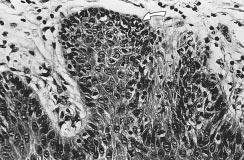A presença de displasia epitelial representa em termos evolutivos um quadro intermediário entre a hiperceratose sem displasia e o carcinoma in situ ou carcinoma invasivo.
