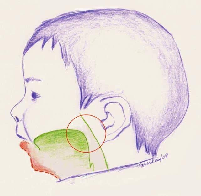 Figura 1: Língua e queixo no bebê sem SPR Na área dentro do círculo vermelho note como tem mais espaço entre língua e