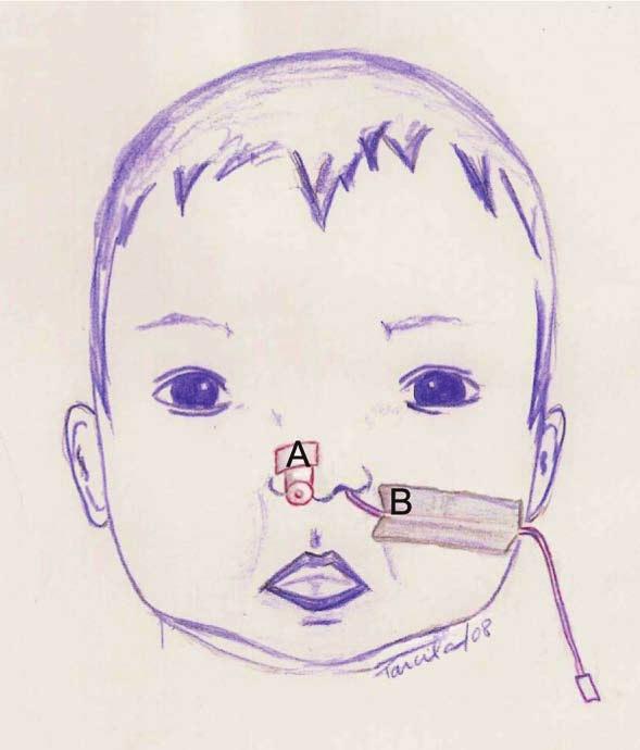 Figura 3: Bebê com a cânula respiratória (A) visto de lado Figura 4: Bebê com a