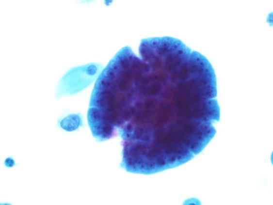 relação núcleo/citoplasmática, a anisocariose, a presença de nucléolos evidentes, e a irregularidade da cromatina podem ser observadas tanto no Adenocarcinoma Endocervical como no Adenocarcinoma