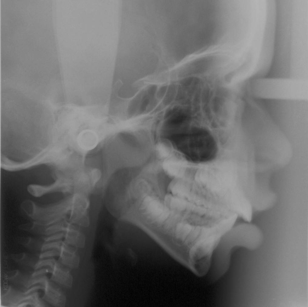 A Figura 2 ilustra a imagem de uma radiografia cefalométrica de perfil realizada segundo as normas de BROADBENT. Figura 2. Imagem da radiografia cefalométrica de perfil do paciente número 04 da amostra desta pesquisa.