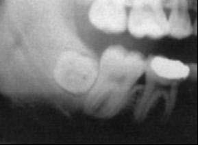 FIGURA 10 - Dente 48