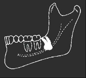 mesioangular acentuada. FIGURA 11 - Representação esquemática de terceiro molar inferior retido em posição invertido.