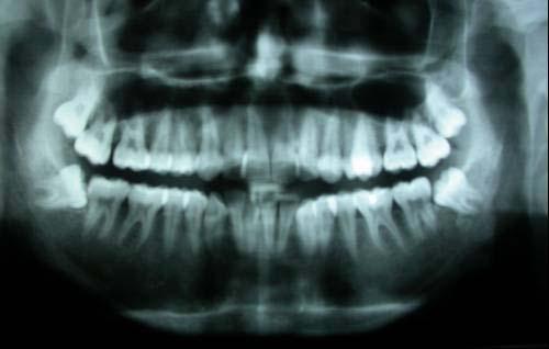 quando à inclinação em relação ao segundo molar adjacente e quanto à classe e dente 48 também classificado quando à