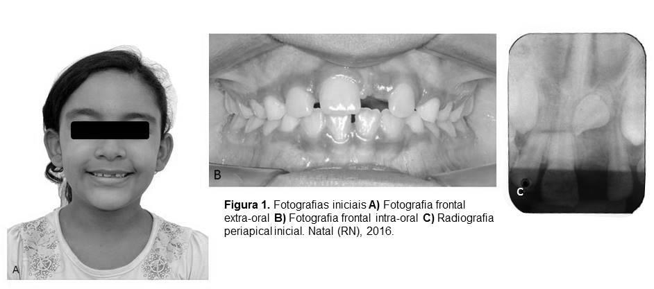 13 A conduta clínica proposta para o caso foi o de recuperação de espaço, seguida de tracionamento ortodôntico pela técnica de erupção fechada.