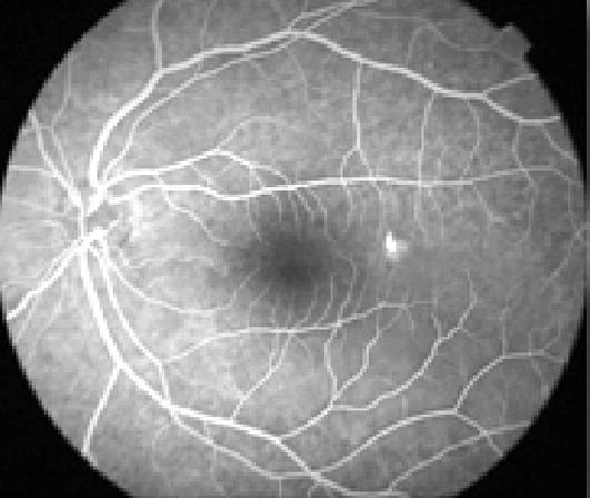 Coroidoretinopatia central serosa 387 forma semelhante àquela que acomete o sexo oposto. As mulheres portadoras de CCS estão geralmente acima dos 40 anos.