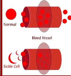23 Normal Vasos sangüíneos Célula Falcizada Figura 6 Vaso-Oclusão Fonte: www.emedicine.com/.../24681132med2126-05.