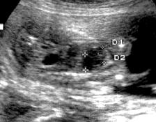 Observa-se duas estruturas circulares anecóicas em região abdominal (Estômago e Bexiga).