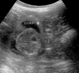 Cálculos segundo Nyland e Matton (2002): IG = 53,9 dias, DAP = 11,1 dias. corpo FIGURA 25 Imagem ultra-sonográfica de gestação com 45 dias após cobertura.