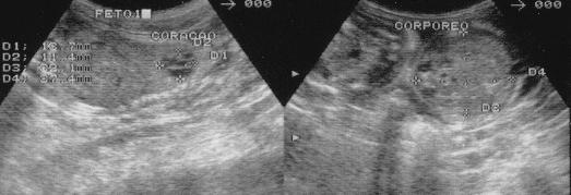 Resultados 65 Coração x x x x corpo x x x x A B FIGURA 26 Imagem ultra-sonográfica de gestação com 56 dias após cobertura. Lado A: Mensuração do coração 12,5 mm.