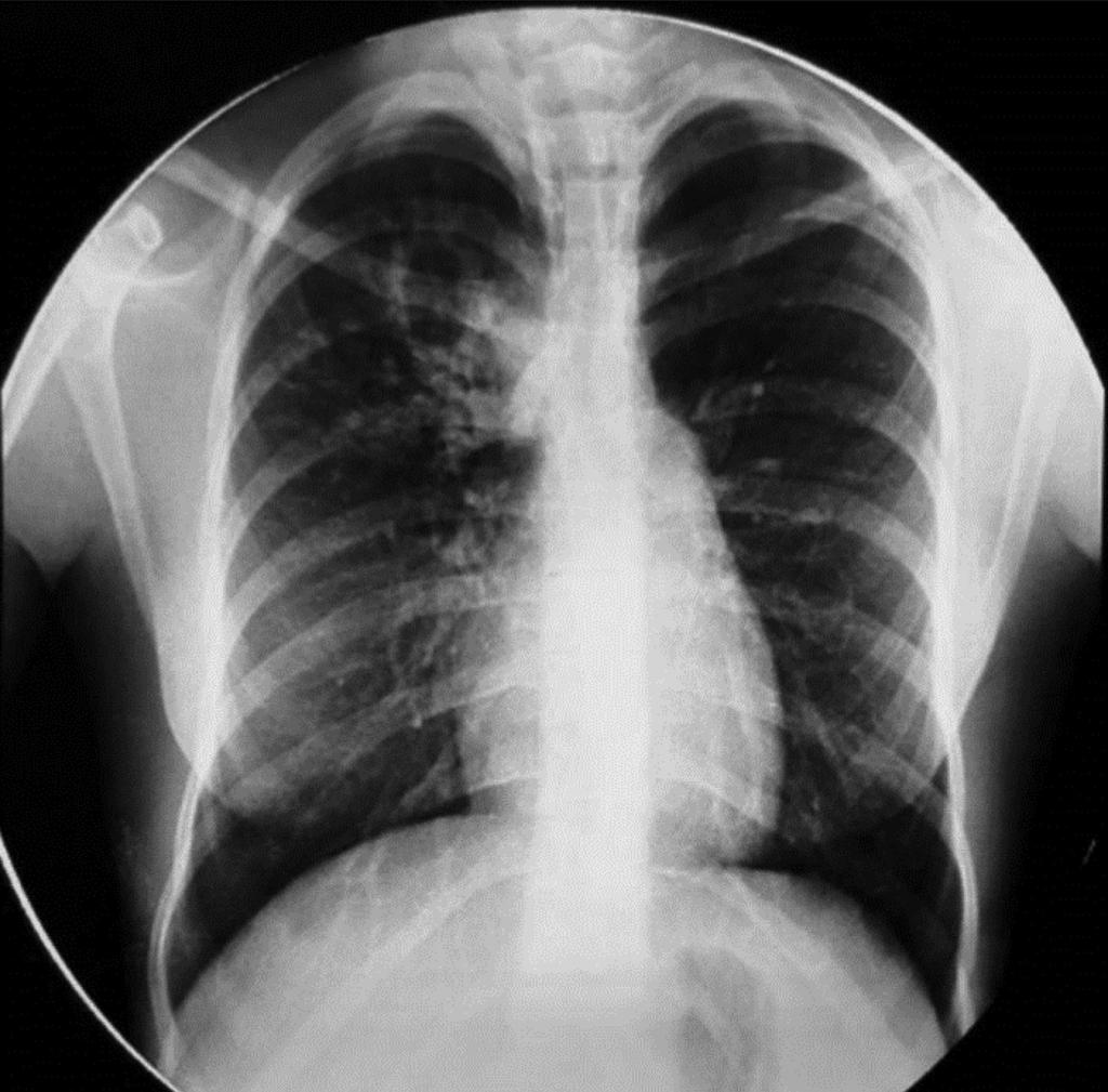 Em Portugal, a TB tem vindo a diminuir, encontrando-se em 2014 com uma taxa de incidência de 20 casos por 100 000 habitantes, permitindo a sua definição como país de baixa incidência.
