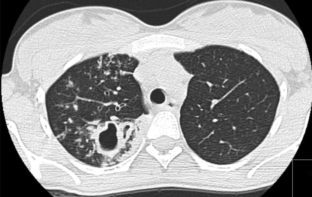 4 A TBMR manteve-se estável, com 22 casos em 2012, 17 em 2013 e 23 em 2014 (representando 1% do total de casos de TB notificados).