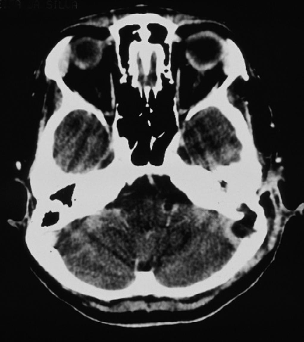 Figura 3. Tomografia Computadorizada de crânio com contraste demonstrando realce de contraste em torno do seio sigmóide e ausência do realce no seu interior com erosão óssea para a fossa posterior.