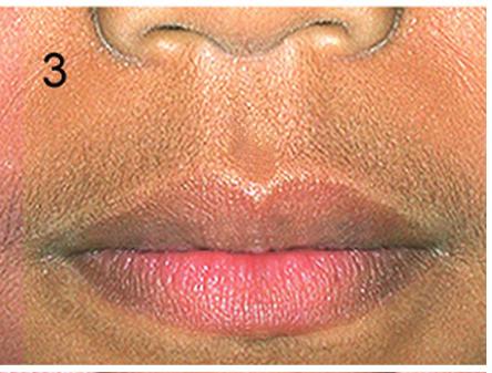 lábiofiltro / Lip-Philtrum