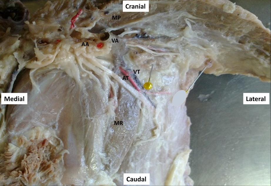 26 Figura 1 Fotografia de peça anatômica ilustrando a região axilar esquerda de um cão adulto. Linfonodo axilar (fixado por alfinete).