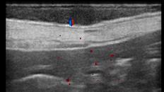 41 A B C Fig.1- Imagens ultrassonográficas de tumores de mama maligno em modo Doppler.