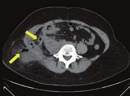 Caso Clinico - Doença de Crohn Ileocecal Associado A Fístula Íleo-Psoas-Cutânea sistêmica, e colocação de um cateter duplo J em ureter direito pelo Serviço de Urologia.