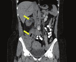 A TC de abdome e pelve de controle, realizado com contraste venoso, evidenciou um trajeto fistuloso do íleo terminal para o retroperitôneo e região inguinal direita, com melhora das coleções, porém